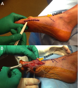 Approach to Hallux Valgus